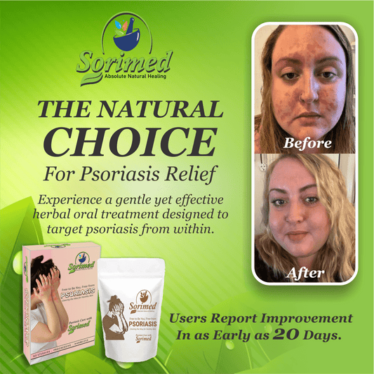 Sorimed – Absolute Natural Healing (30 Days Oral Support) - LVTS Leucoderma/Vitiligo Treatment System
