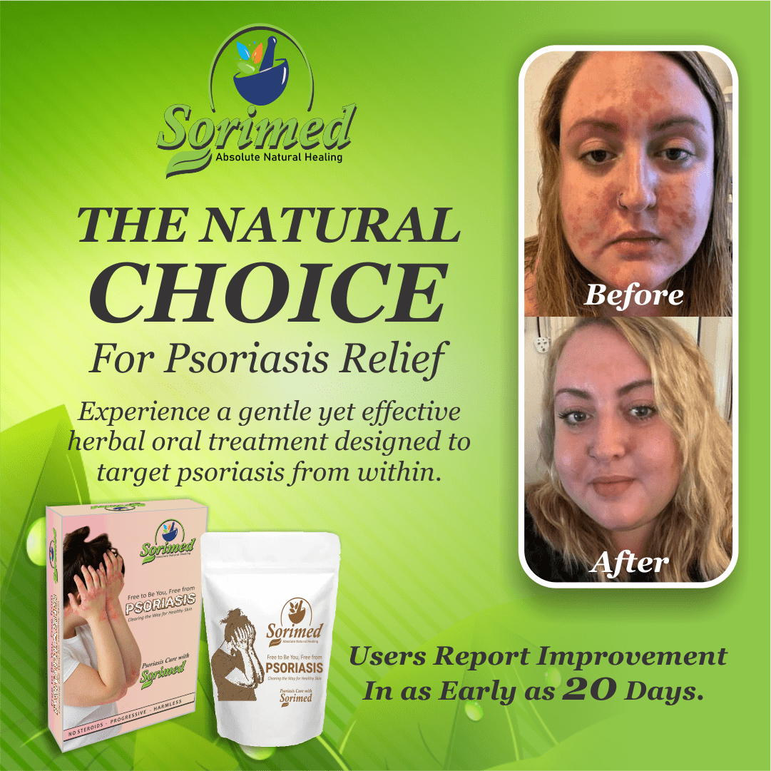 Sorimed – Absolute Natural Healing (30 Days Oral Support) - LVTS Leucoderma/Vitiligo Treatment System